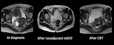 Modified DCF (Docetaxel, Cisplatin and 5-fluorouracil) chemotherapy is effective for the treatment of advanced rectal squamous cell carcinoma